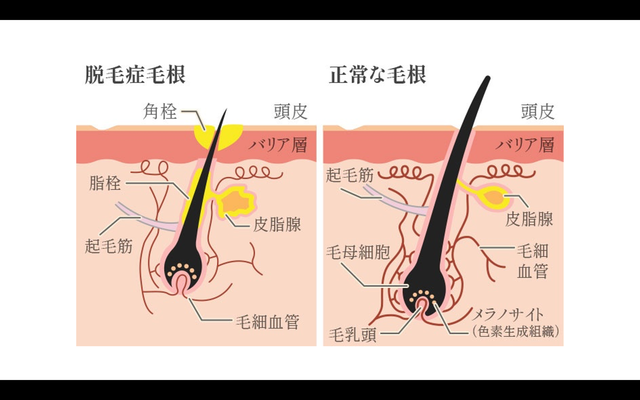 正常な毛根と脱毛症毛根の比較
